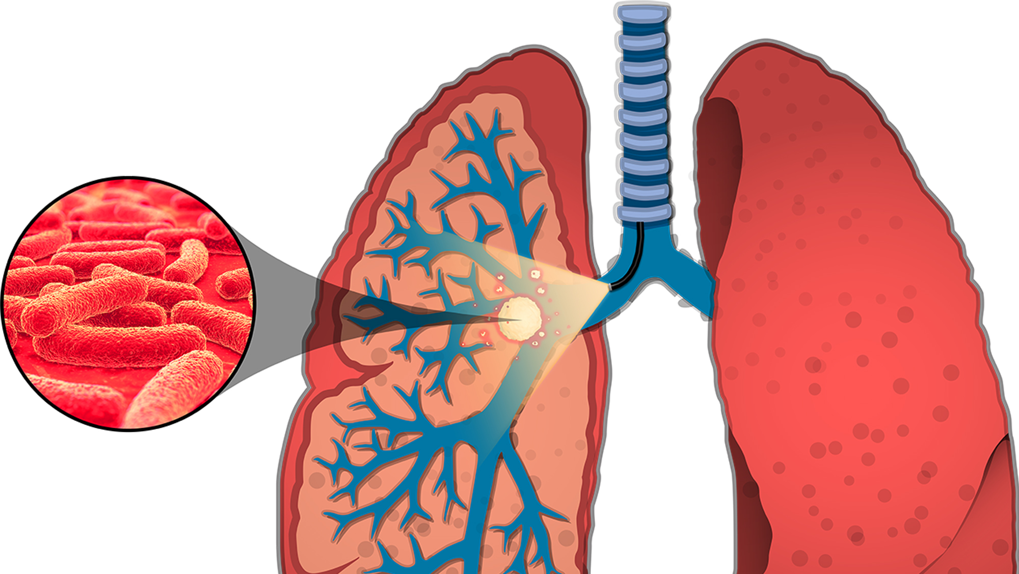 Graphic of tuberculosis imaging in a lung