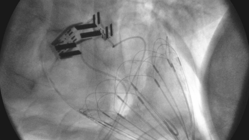 X-ray image of cardiovascular device