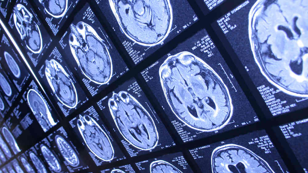 Grid of gray scale MRI brain scans