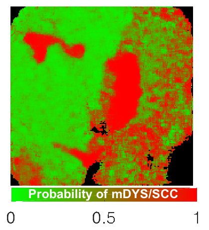 Scan of an oral lesion that highlights differernt portions with color to show probability of a pre-cancerous or cancerous lesion.