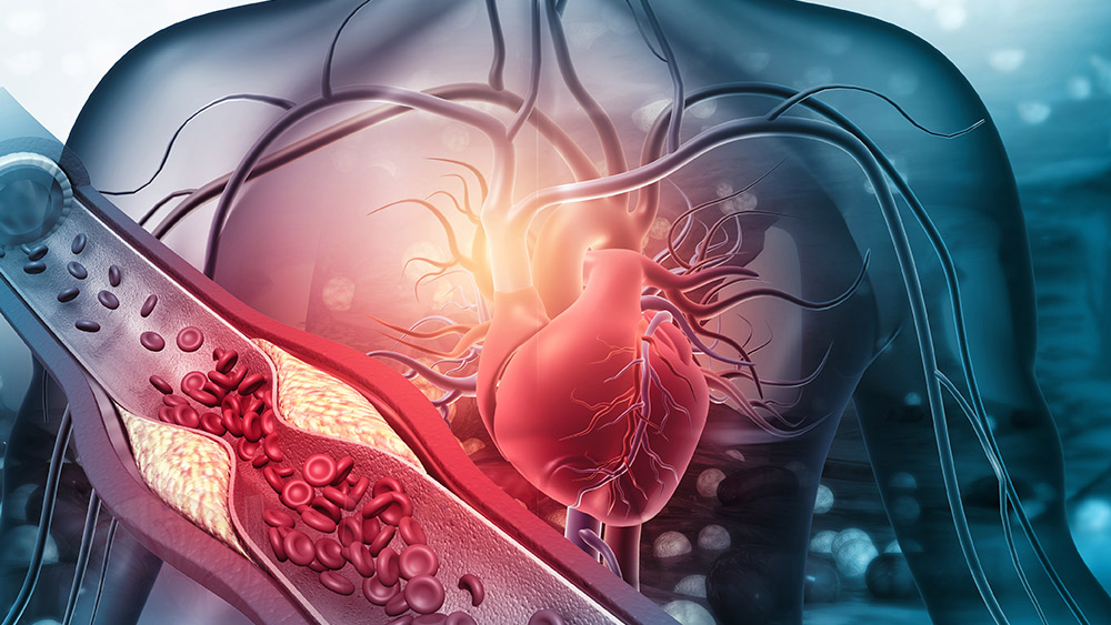 Illustration of a human chest showing an artery with clotting blood