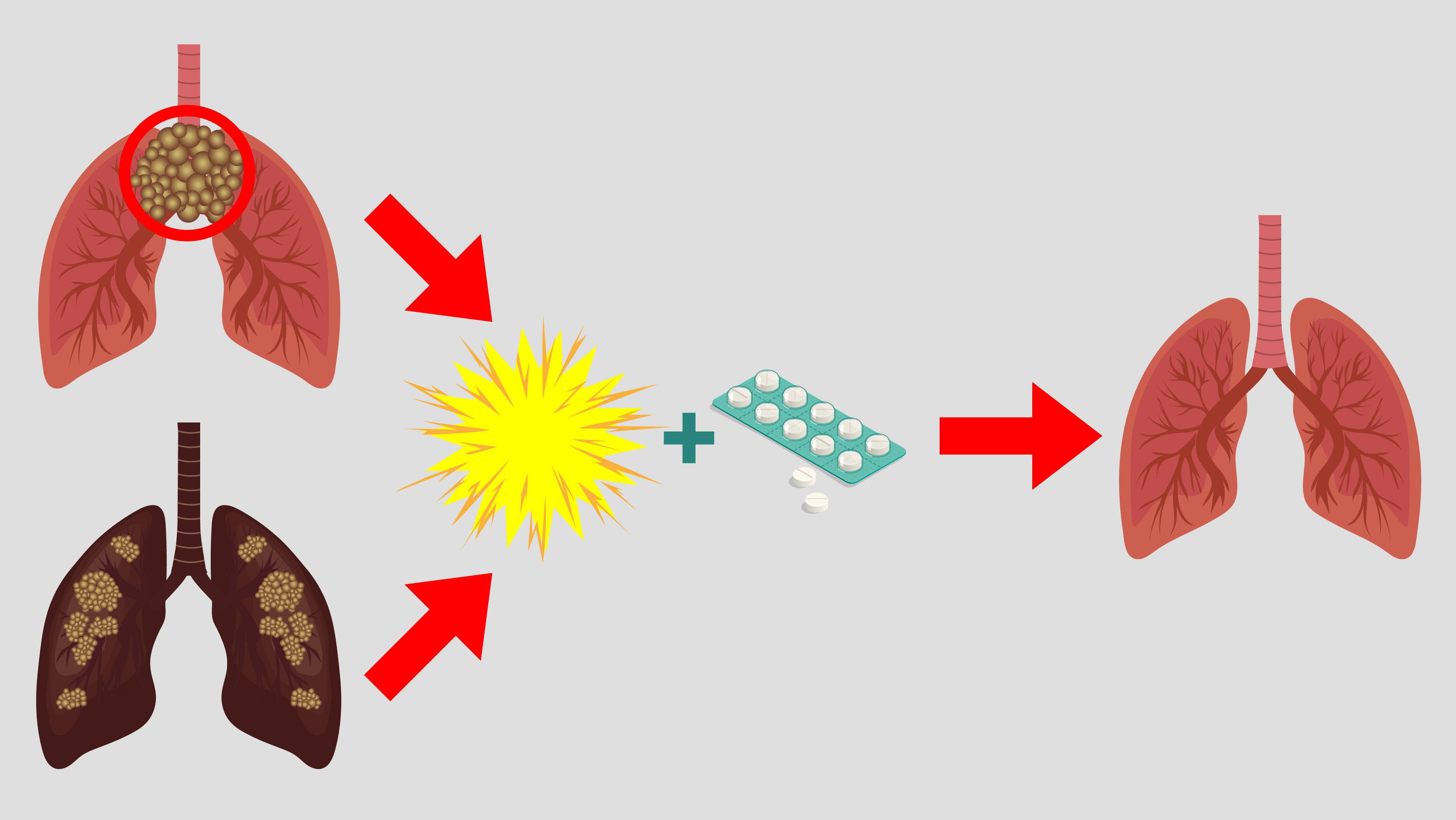 An illustration showing photodynamic activation for treating antibiotic-resistant pneumonia.