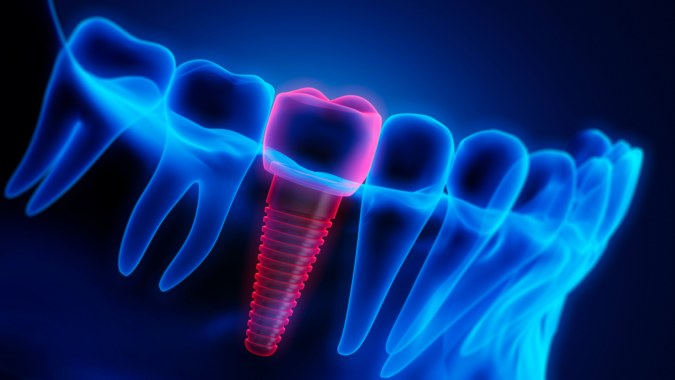 3D illustration of a dental implant being placed in the jaw, surrounded by human teeth.  